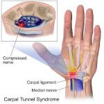 Carpal Tunnel Syndrome ⋆ Loveland Orthopedic Massage Therapy